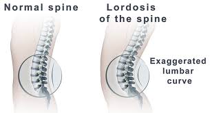 تمرینات مناسب برای افراد دچار گودی بیش از حد ستون فقرات کمری